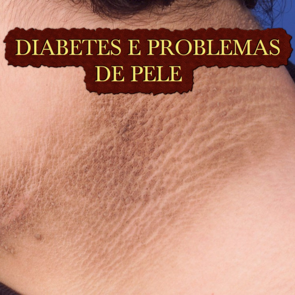 diabetes: consequências - problemas de pele